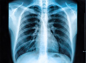 An X-ray of the chest showing the lungs, heart and ribs